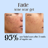 Fade - Acne Scar Gel